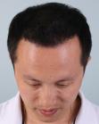 After Hair Transplant&nbsp;Front